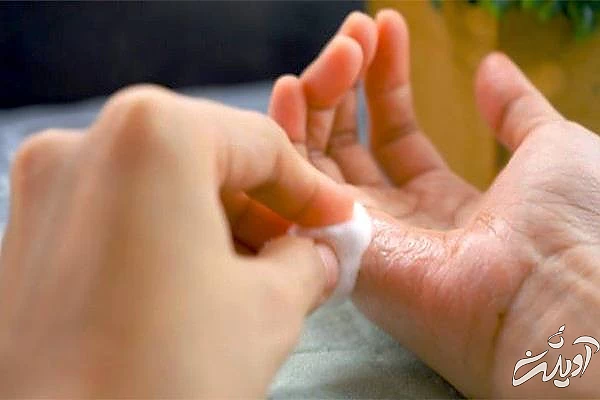 حلال چسب 123 روی پوست